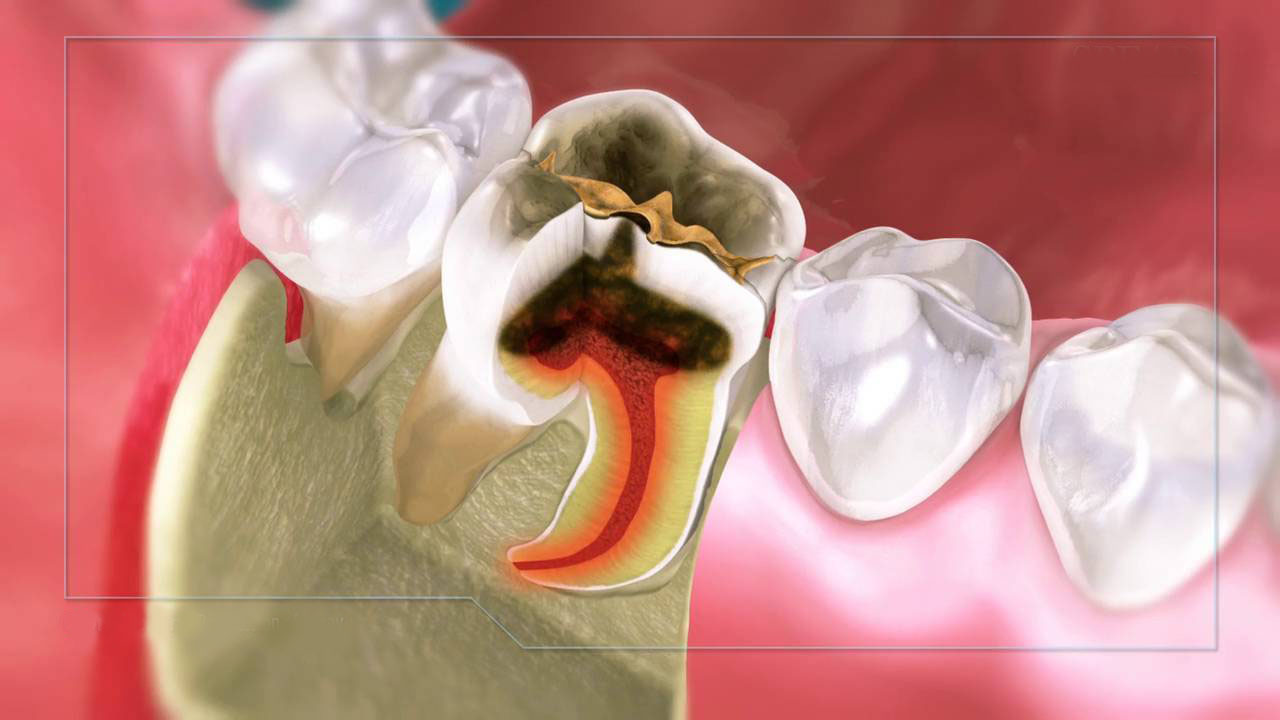 Viêm tủy răng và những biến chứng nguyên hiểm của nó Viêm tủy răng và những biến chứng nguyên hiểm của nó