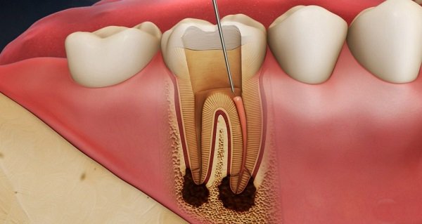 Viêm tủy răng và những dấu hiệu mà bạn nên biết