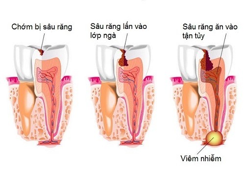 Viêm tủy răng và những dấu hiệu mà bạn nên biết