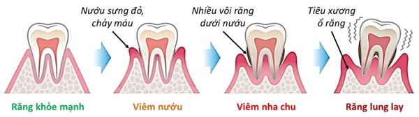 Bảng giá viêm nha chu Bảng giá viêm nha chu