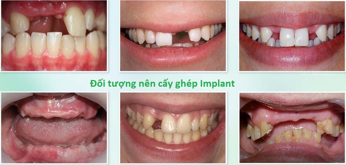 Trồng răng implant Trồng răng implant