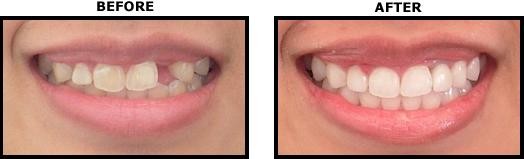 Trồng răng implant Trồng răng implant