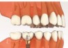 Bệnh viêm quanh implant ở bệnh nhân trồng răng implant