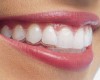 Niềng răng invisalign có hiệu quả không