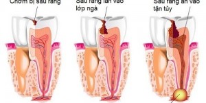 Bảng giá Điều trị tủy răng