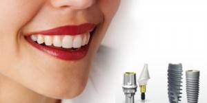 Bảng giá trồng implant