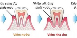 Bảng giá viêm nha chu