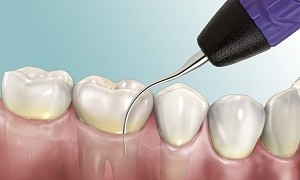 4 lý do hàng đầu cần kiểm tra sức khỏe răng miệng thường xuyên