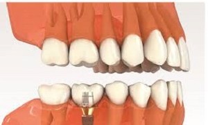 Bệnh viêm quanh implant ở bệnh nhân trồng răng implant