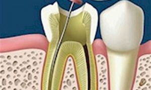Cách điều trị tủy răng – nội nha