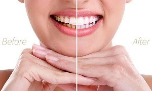 Cạo vôi răng định kỳ bảo vệ sức khỏe răng miệng cho gia đình bạn