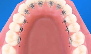 Cấu tạo và đặc điểm của các loại hình niềng răng phổ biến