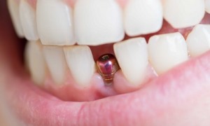 Cấy ghép Implant và những điều bạn cần lưu ý