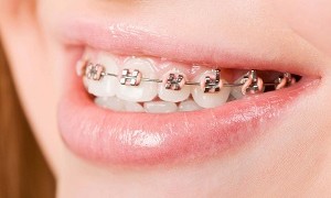 Chỉnh răng móm bằng phương pháp niềng răng