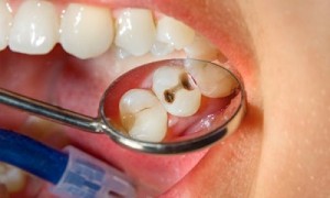 Chữa tủy răng tại quận 10