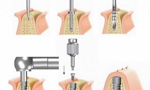 Có được uống rượu bia sau khi cấy ghép răng implant không