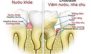 Dấu hiệu của bệnh viêm nha chu