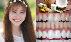 Khai phá công dụng tối ưu của dầu dừa trong việc bảo vệ răng miệng nhà bạn