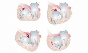 Nên hay không nên loại bỏ răng khôn