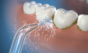 Nguyên nhân gây ra mảng bám răng và cách loại bỏ chúng