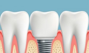 Những  lợi ích của việc trồng implant mang lại