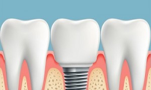 Những  lợi ích của việc trồng implant mang lại