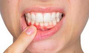 Những nguy hiểm tiềm tàng của bệnh nướu răng