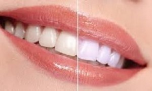 Những thông tin cần biết về máng tẩy trắng răng