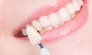Những ưu điểm không ngờ từ phương pháp bọc răng sứ