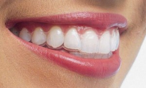 Niềng răng invisalign có hiệu quả không