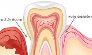 Răng bị mẻ thì phải làm sao