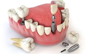 Răng implant sử dụng được bao lâu thì phải làm lại