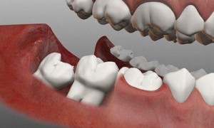 Răng khôn có tác dụng gì và khi nào nên nhổ răng khôn