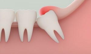 Răng khôn và những điều cần biết khi nhổ răng khôn
