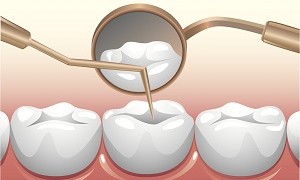 Sâu răng và những vấn đề liên quan mà bạn cần biết