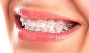 Tác dụng của niềng răng mà bạn nên biết