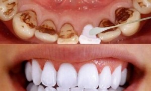 Tẩy trắng răng tại Tân Phú