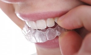 Tẩy trắng răng tại quận 10