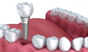 Tìm hiểu về quy trình cấy ghép răng implant