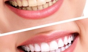 Top những công nghệ tẩy trắng răng hiệu quả nhất hiện nay