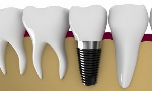 Trồng implant tại tân phú