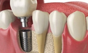 Trồng răng implant tại quận 10