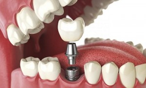 Trồng răng Implant và những điều cần biết