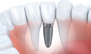 Trường hợp nào nên trồng Implant cho răng