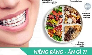 Xây Dựng Thực Đơn Ăn Uống Sau Khi Niềng Răng Chỉnh Nha