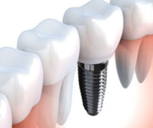 Trồng Implant