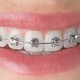 Giải đắp một số thắc mắc về niềng răng